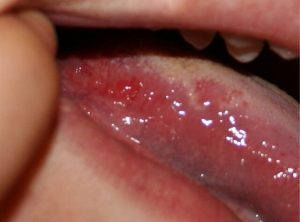 красные пятна которые возникают на поверхности языка